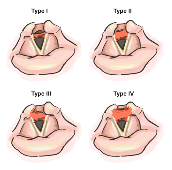 Bogdasarian and Olson Classification of Posterior Glottic Stenosis