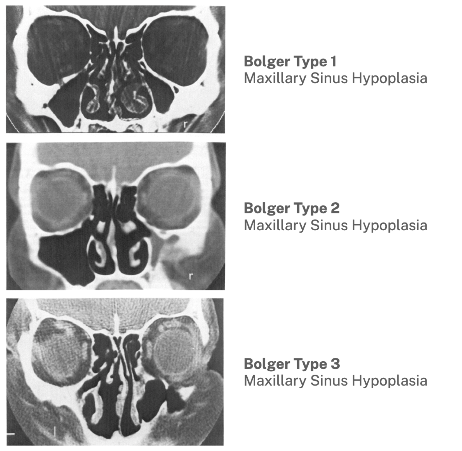 Bolger Classification of Maxillary Sinus Hypoplasia