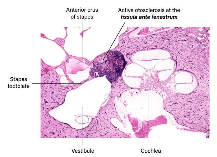 Temporal bone pathology fissula ante fenestram