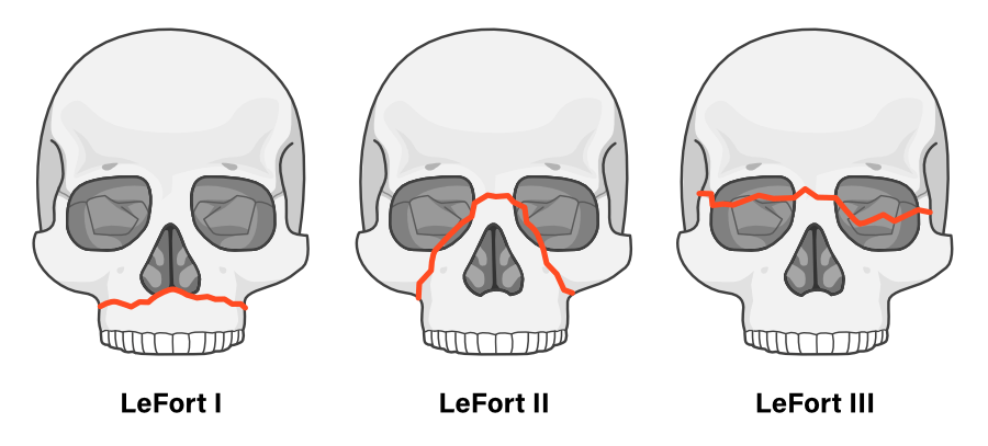 Le Fort Midface fracture classification