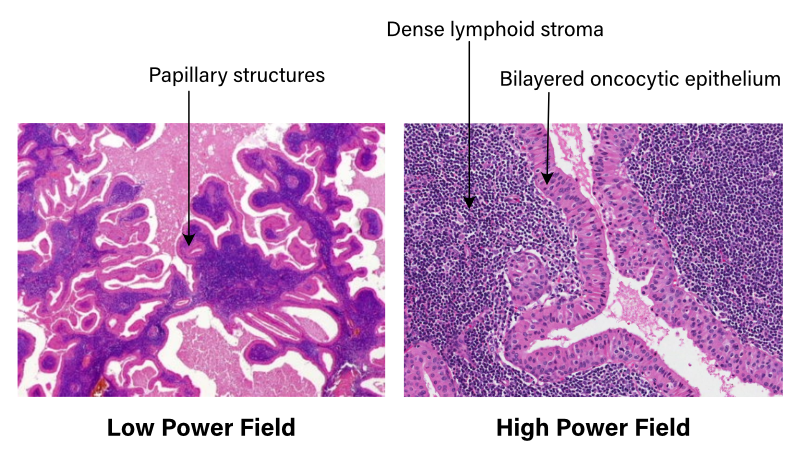 Warthin's tumour histopathology